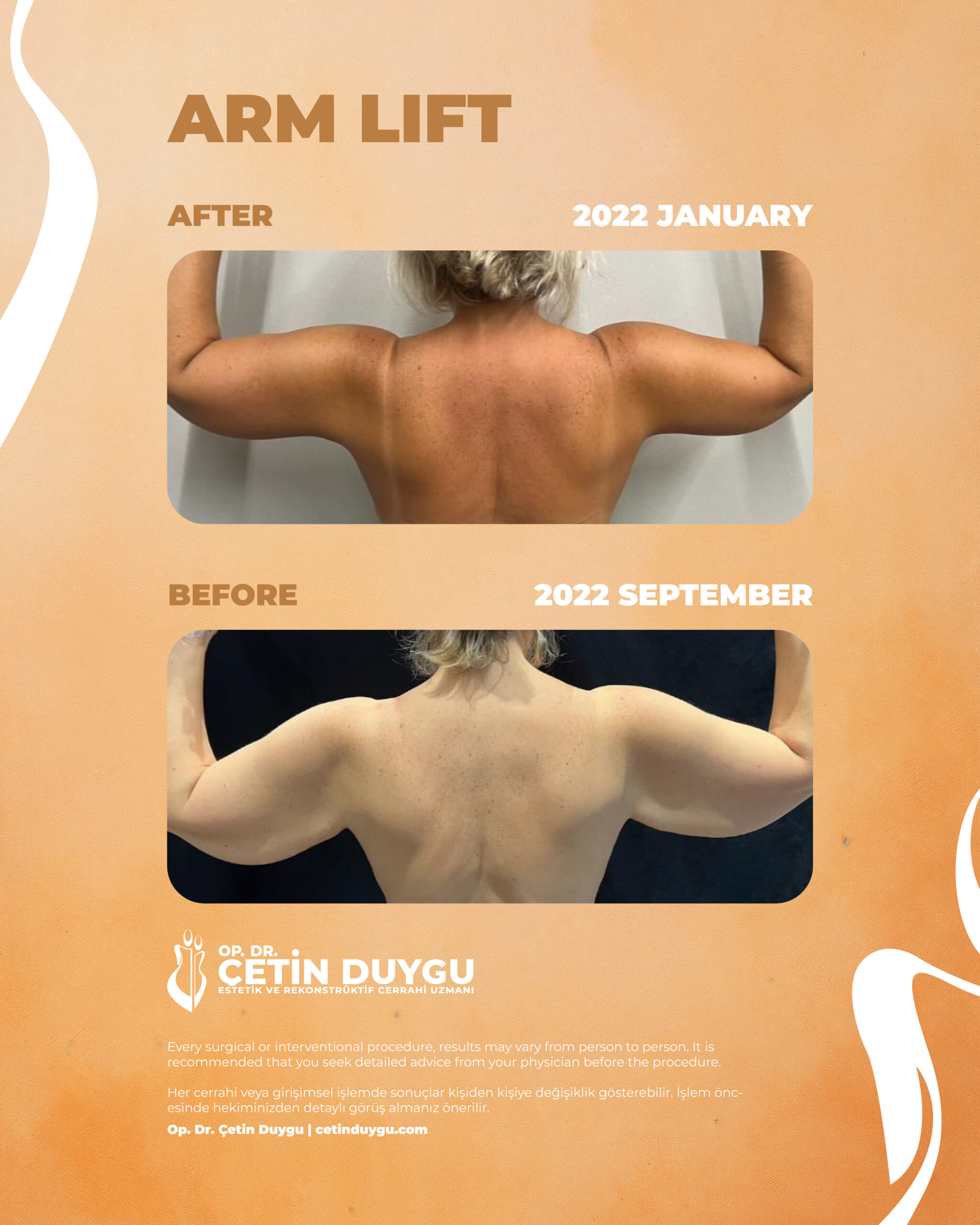 Çetin Duygu_SM_Before & After-03